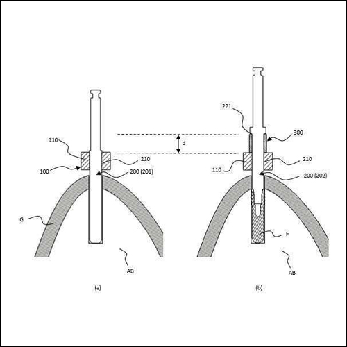 특허 제10-2193710호(정밀 맞춤형 멈춤 기능을 갖춘 임플란트 유도수술 기구 시스템, 이태경)